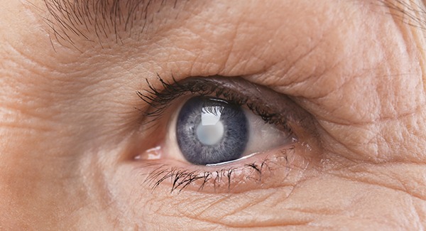 Cataract Surgery