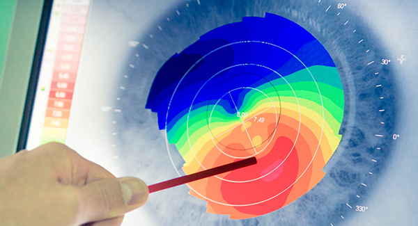 Corneal Transplant