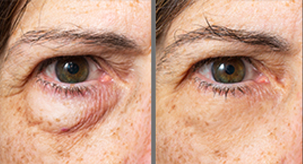 Oculoplastics Eyelid Surgery